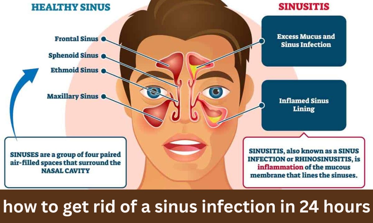 How To Get Rid Of A Sinus Infection In 24 Hours Fast And Effective 